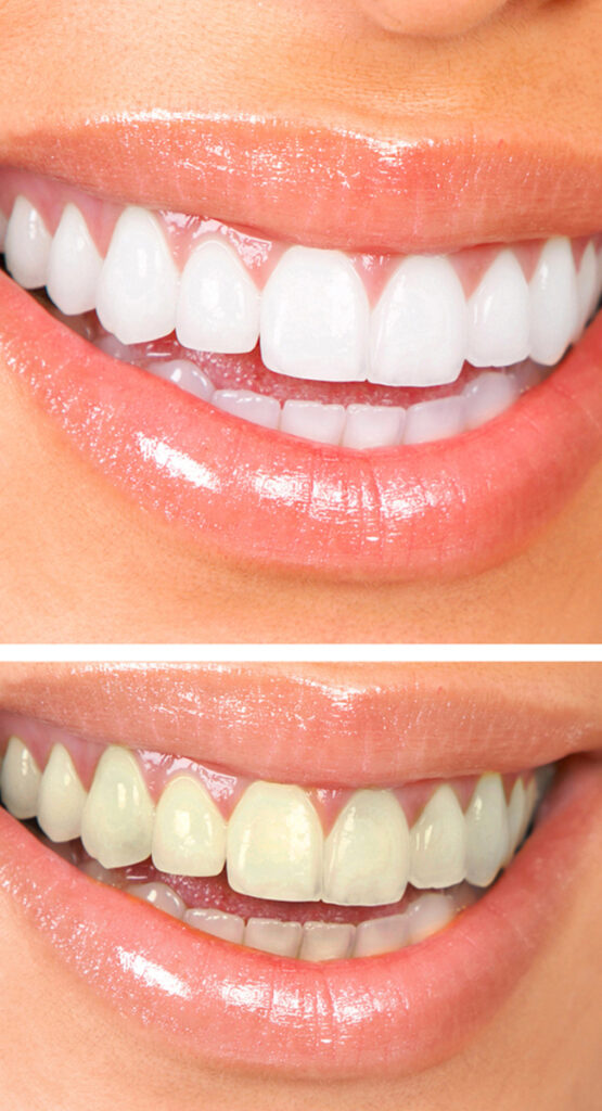 Before & after Hollywood smile treatment in Turkey with BU Clinics