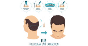 The FUE - Follicular Unit Extraction - An advance hair transplant method