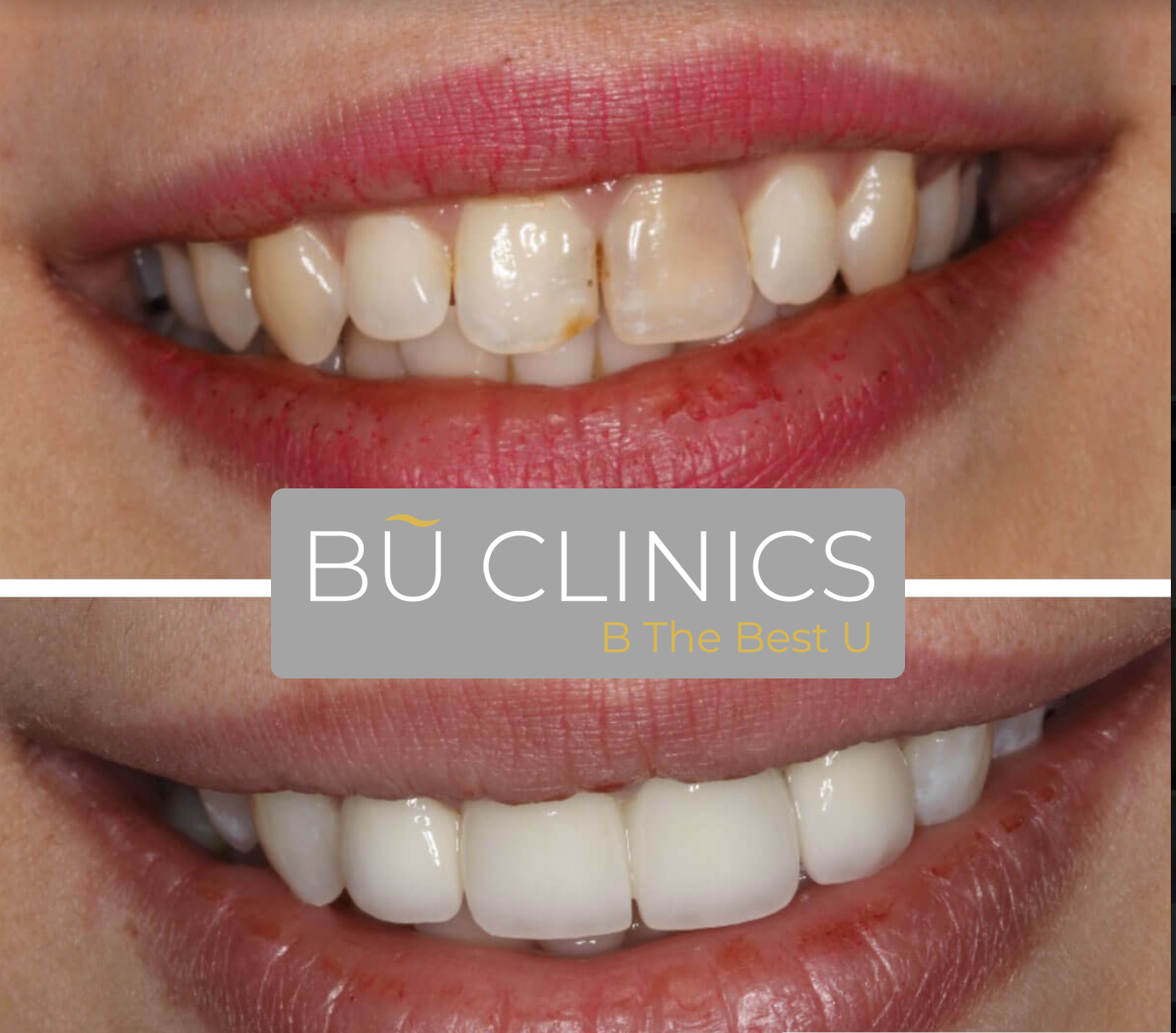 Before & after Hollywood smile treatment in Turkey with BU Clinics